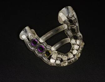 サージカルガイドを使用した安全なインプラント治療